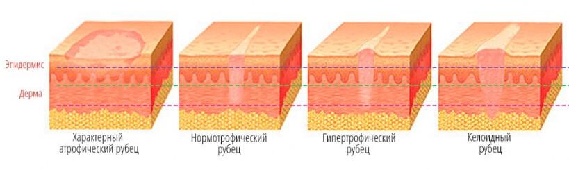 Види рубців