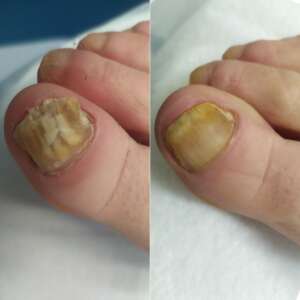лазерне лікування нігтів, резулітат 2 сеансів, Львів, Dermline